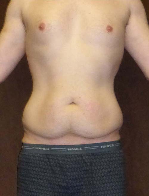 Male Body Contouring