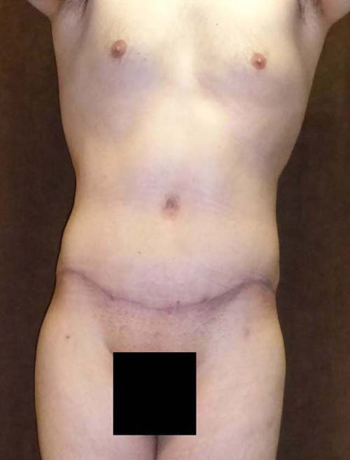 Male Body Contouring