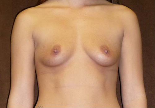 Breast Augmentation/Implants