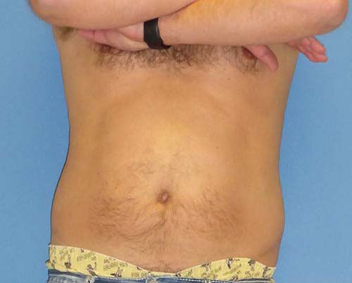 Male Body Contouring