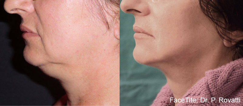 FaceTite Before & after Photos