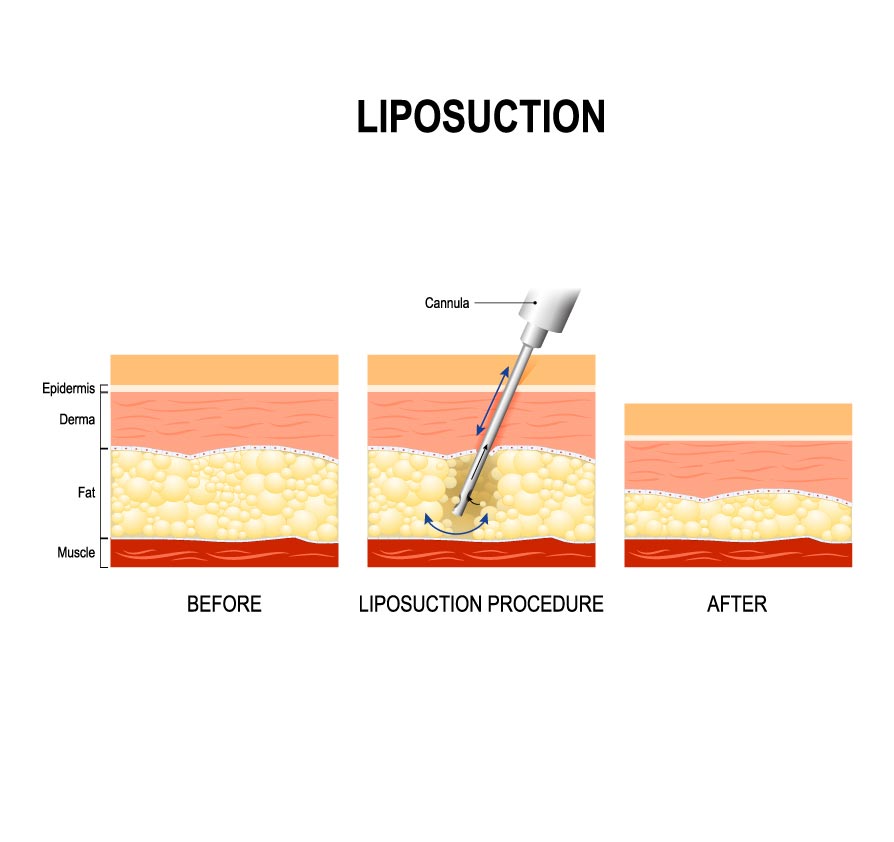 An illustration depicts who liposuction works.