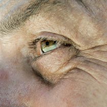 A man with eyebrow surgery poses happily for a photograph.